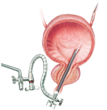 CystoAssist® Systems