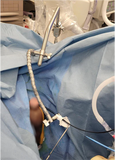 Ureteral Access Sheath (UAS) Stabilization Arm
