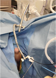 Ureteral Access Sheath Stabilization System